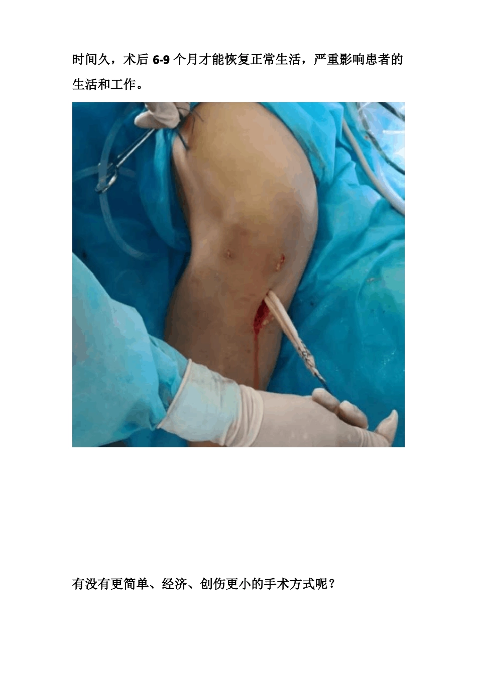 胫骨髁间脊骨折_第3页