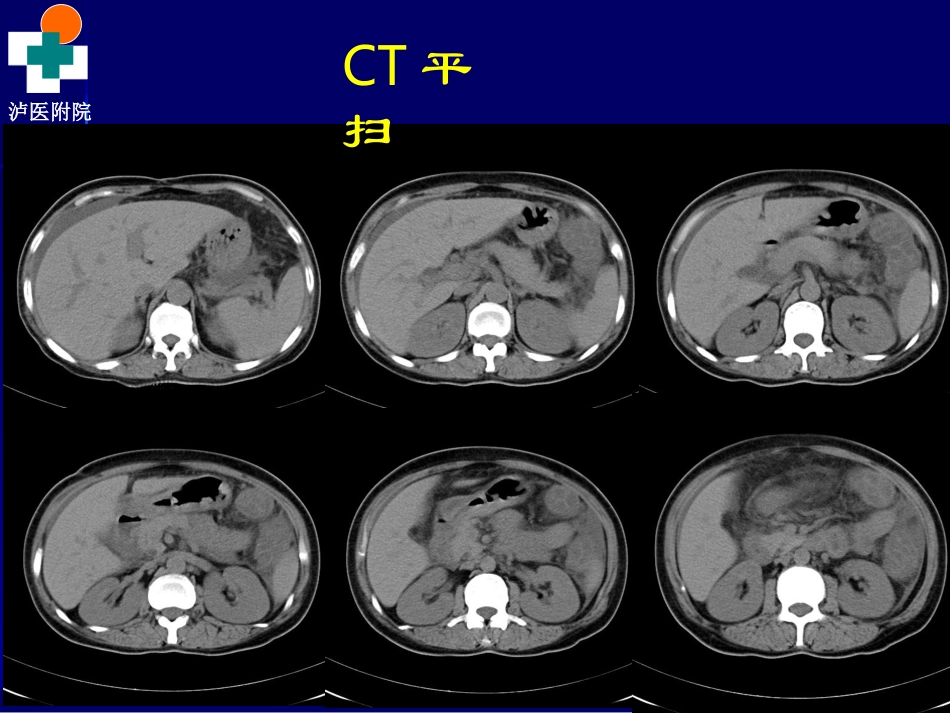 系统性红斑狼疮病例_第3页