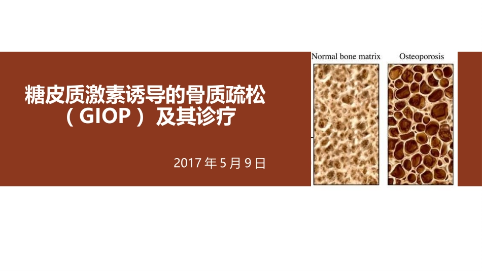 糖皮质激素诱导的骨质疏松_第1页