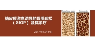 糖皮质激素诱导的骨质疏松
