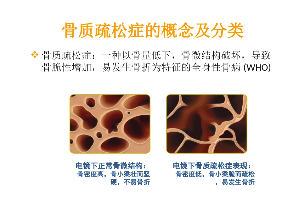 糖皮质激素性骨质疏松症_第3页