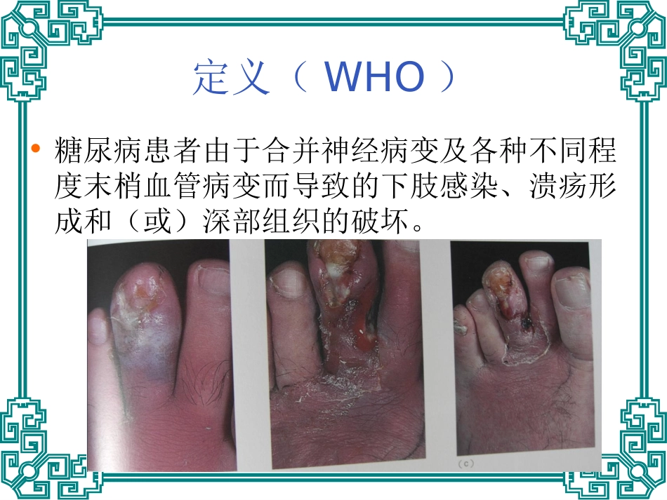 糖尿病足的诊治_第2页