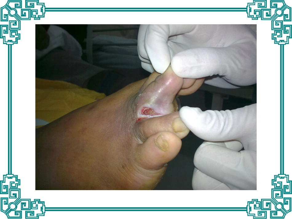 糖尿病足的诊治_第3页