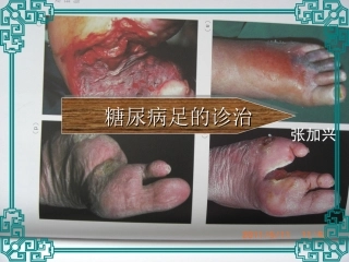 糖尿病足的诊治