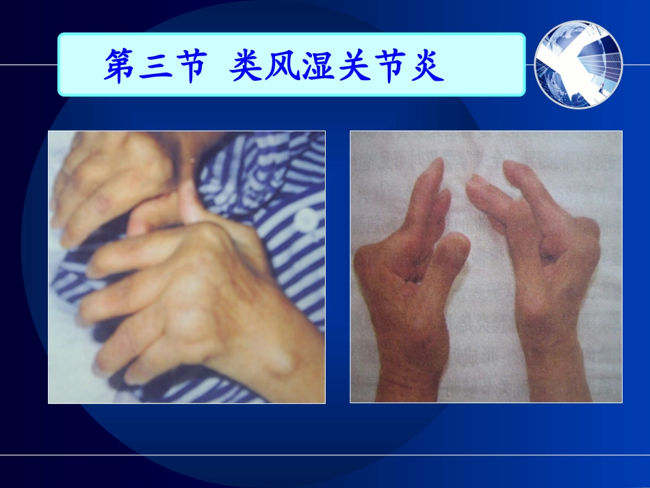 类风湿关节炎_8_2_第2页
