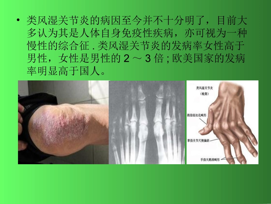 类风湿性关节炎_第2页