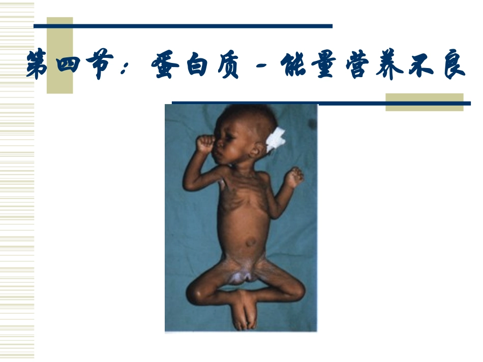 第四节：蛋白质-能量营养不良_第1页