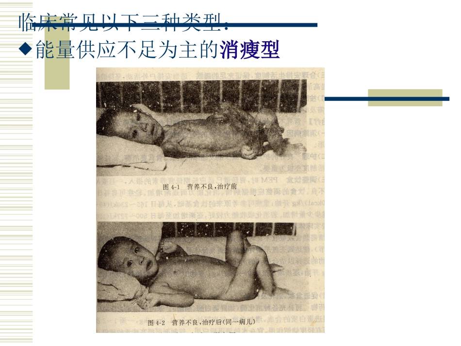 第四节：蛋白质-能量营养不良_第3页