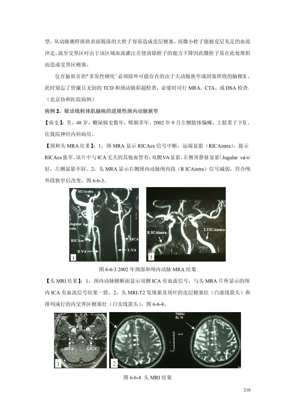 第六章 第六节颈内动脉狭窄临床病例讨论1_第3页