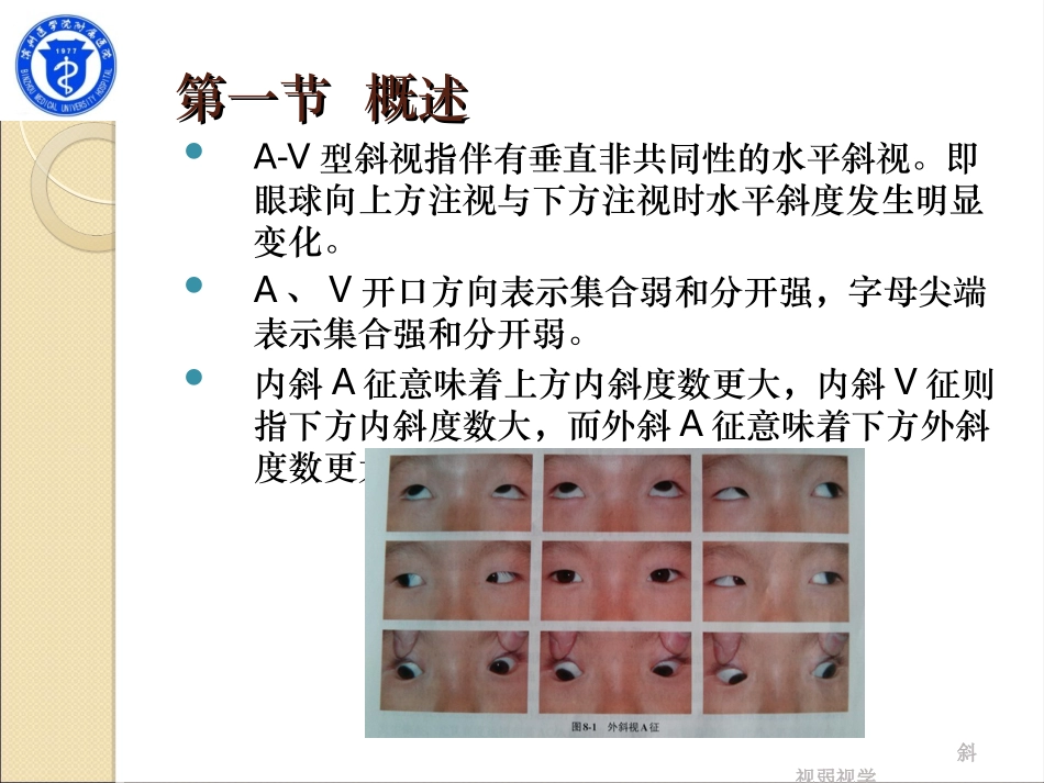 第八章 A-V型斜视_第2页