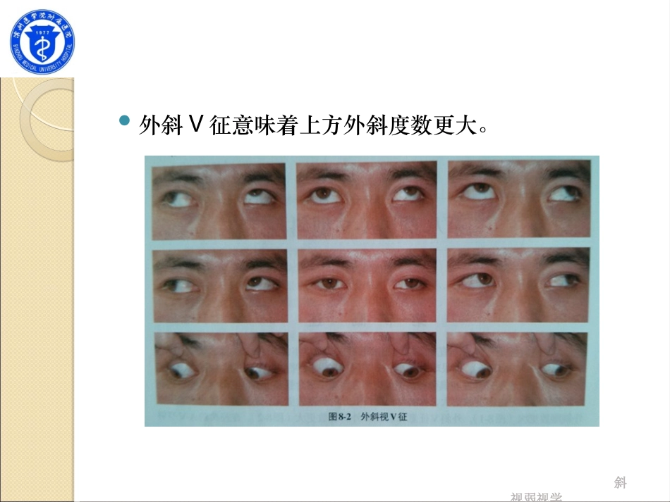 第八章 A-V型斜视_第3页
