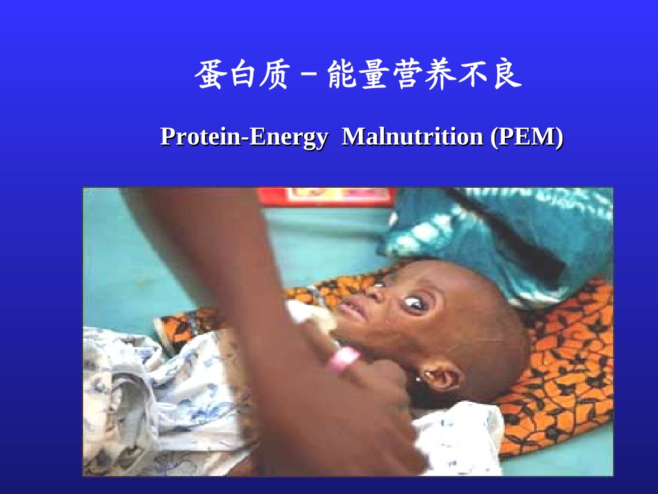 第五章 蛋白质-能量营养不良_第1页
