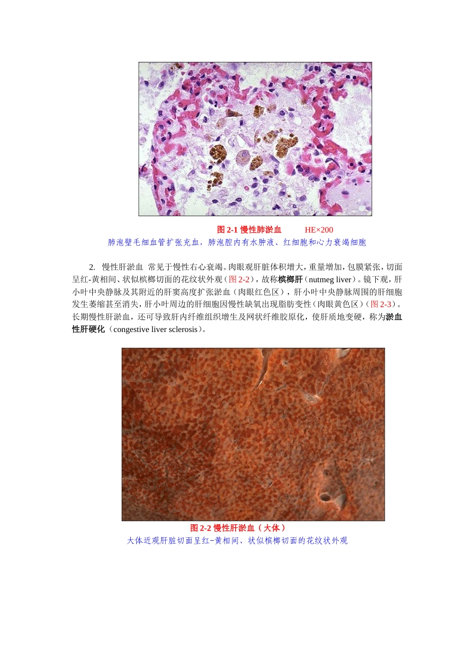 第二章  局部血液循环障碍_第3页