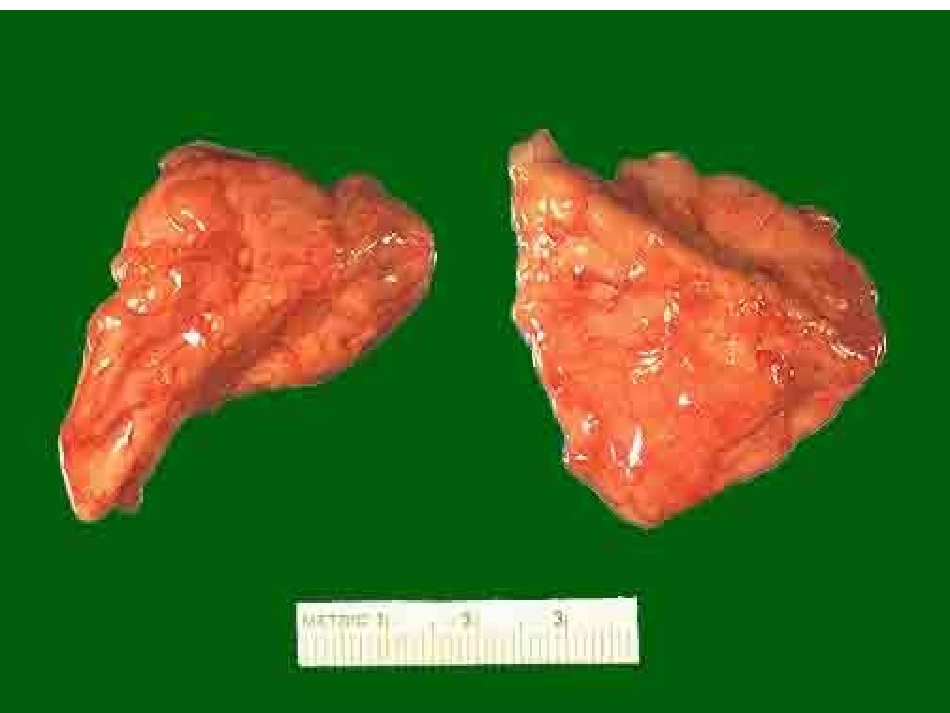 第七篇 第十三章 库欣综合征_第3页