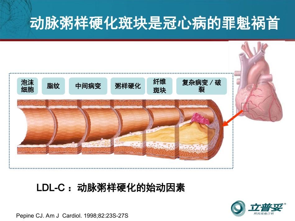 稳定性冠心病不稳定PIM_第3页