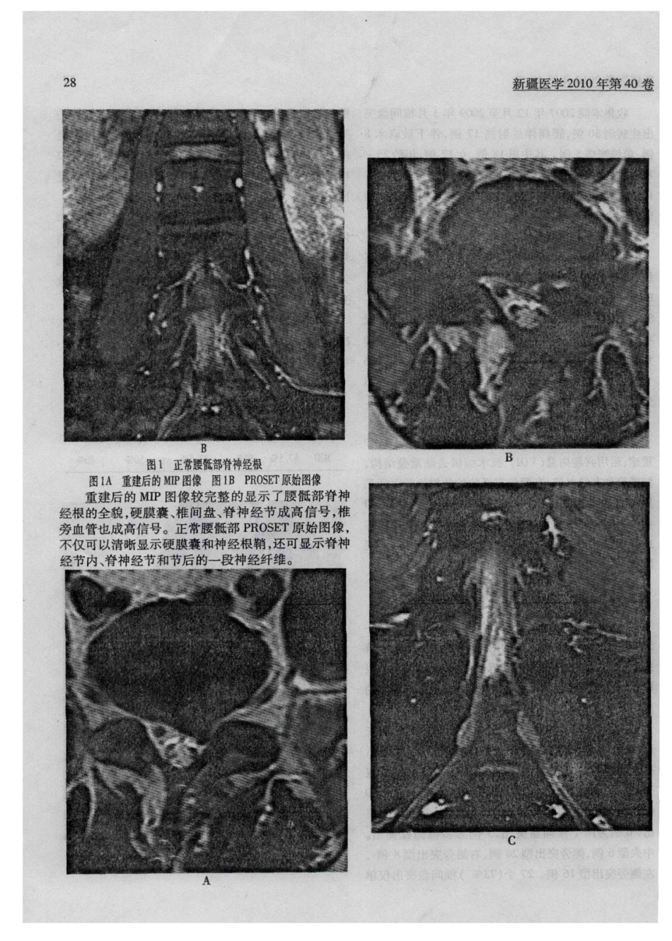 磁共振PROSET技术在腰椎间盘突出症中的应用_第3页