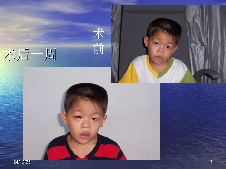 眼外肌麻痹引起的代偿头位_第3页