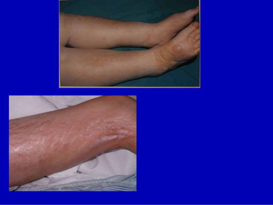 病理学-水肿 (1)_第3页