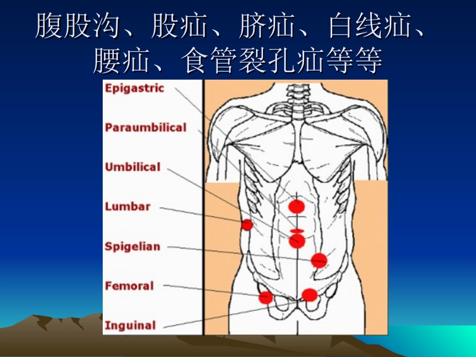 疝和腹壁外科进展_第3页