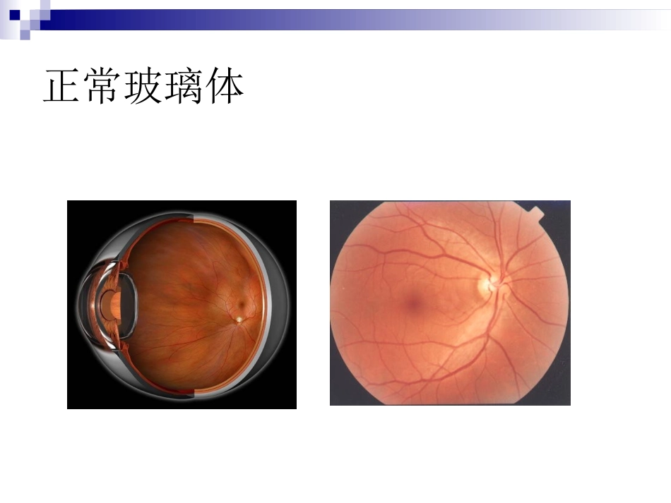 玻璃体液化及玻璃体积血概要_第3页