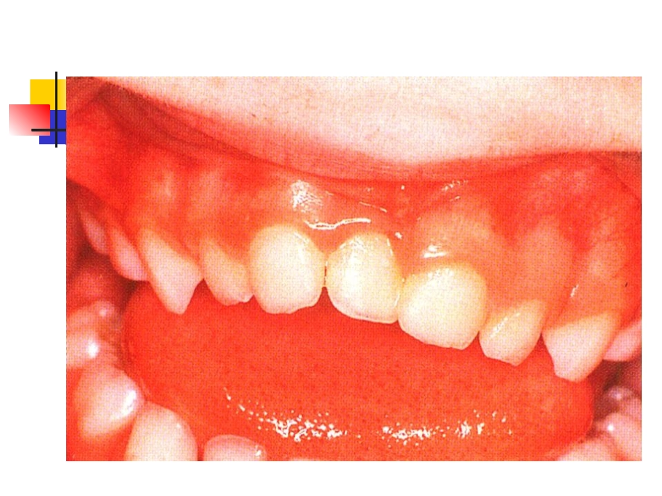 牙周病图1-文档资料_第2页