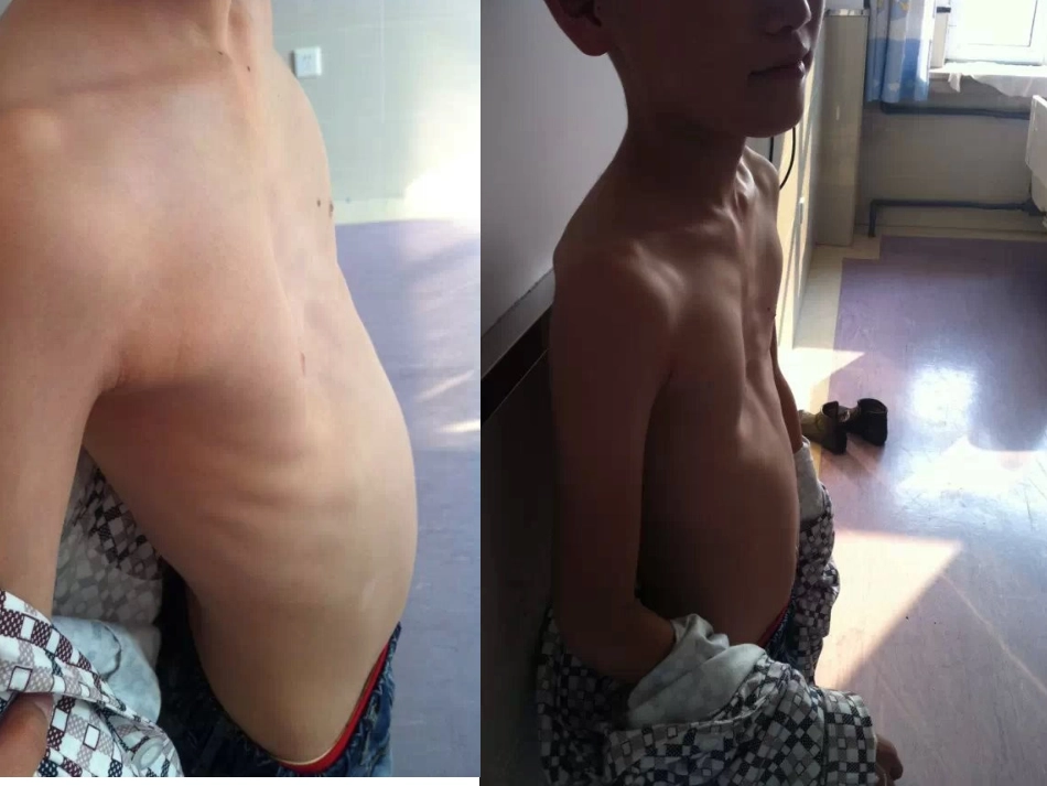 漏斗胸-ppt_第2页