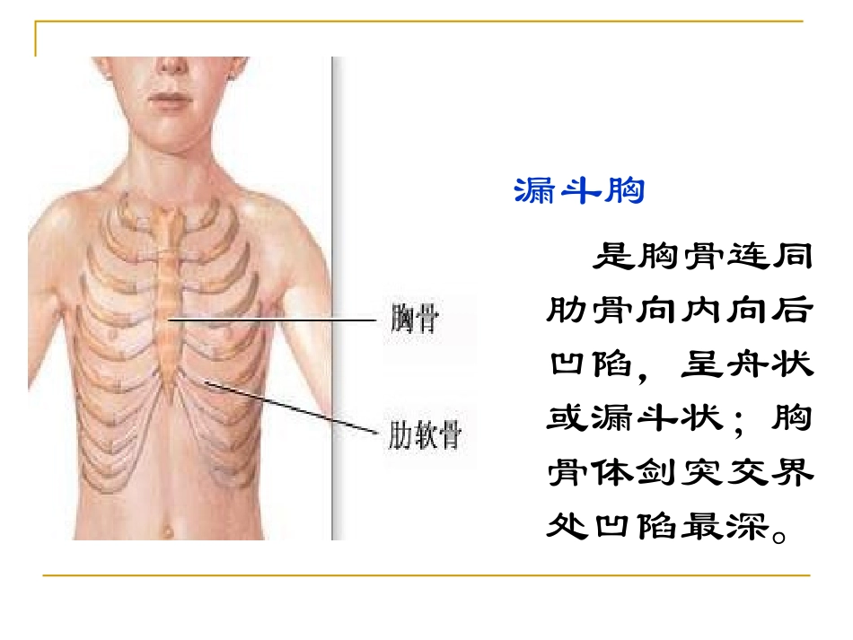 漏斗胸-ppt_第3页