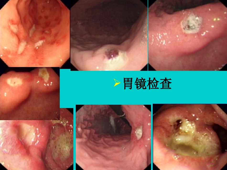 溃疡、肠道易激综合征_第3页