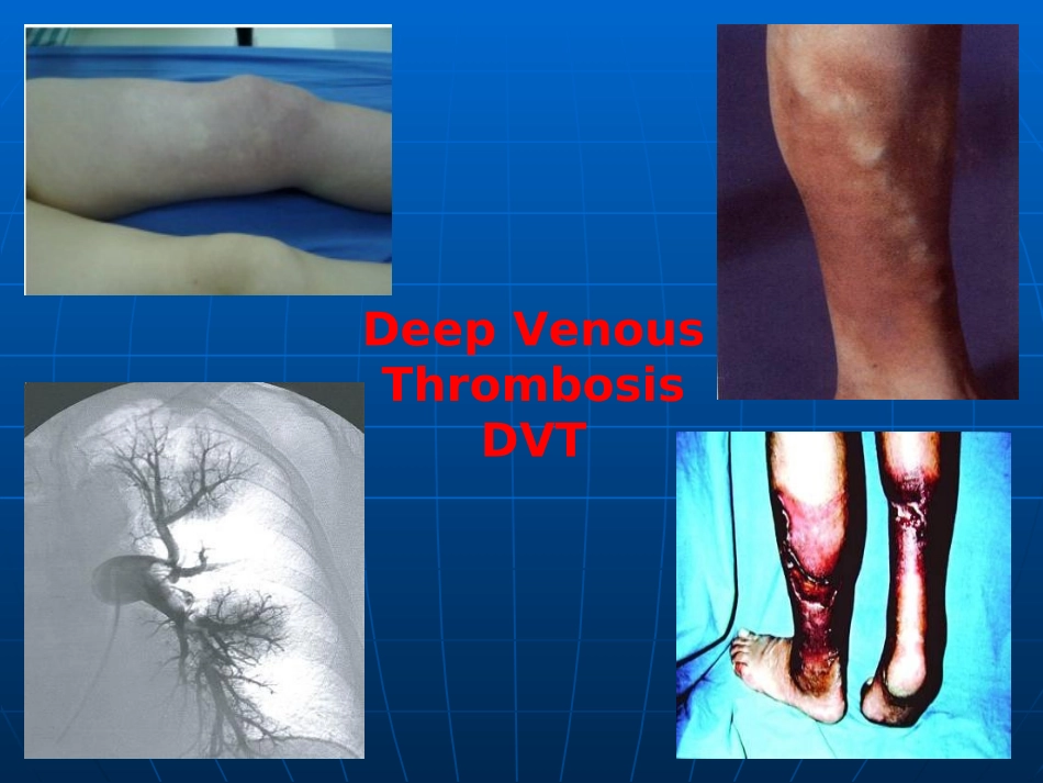 深静脉血栓诊治_第1页