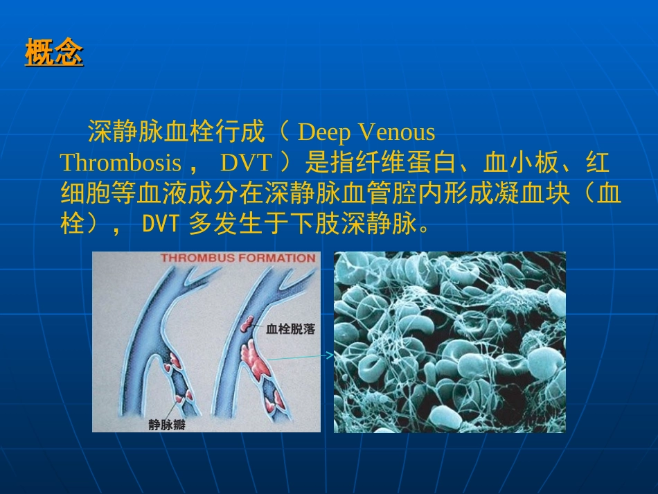 深静脉血栓诊治_第2页