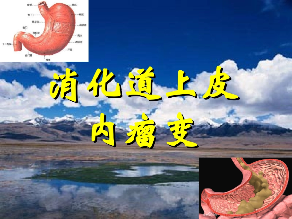 消化道上皮内瘤变_第1页