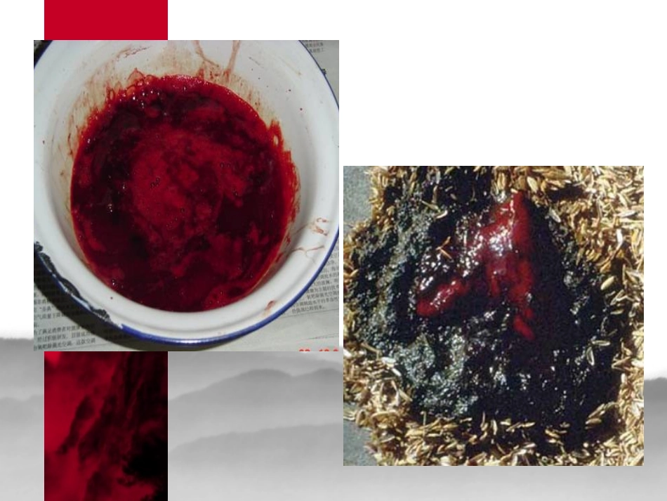 消化道出血-(1)_第2页