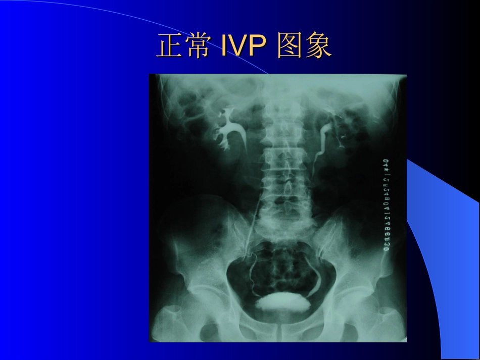 泌尿系统梗阻概论_第3页