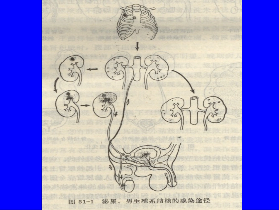 泌尿系及男性生殖系结核_第2页