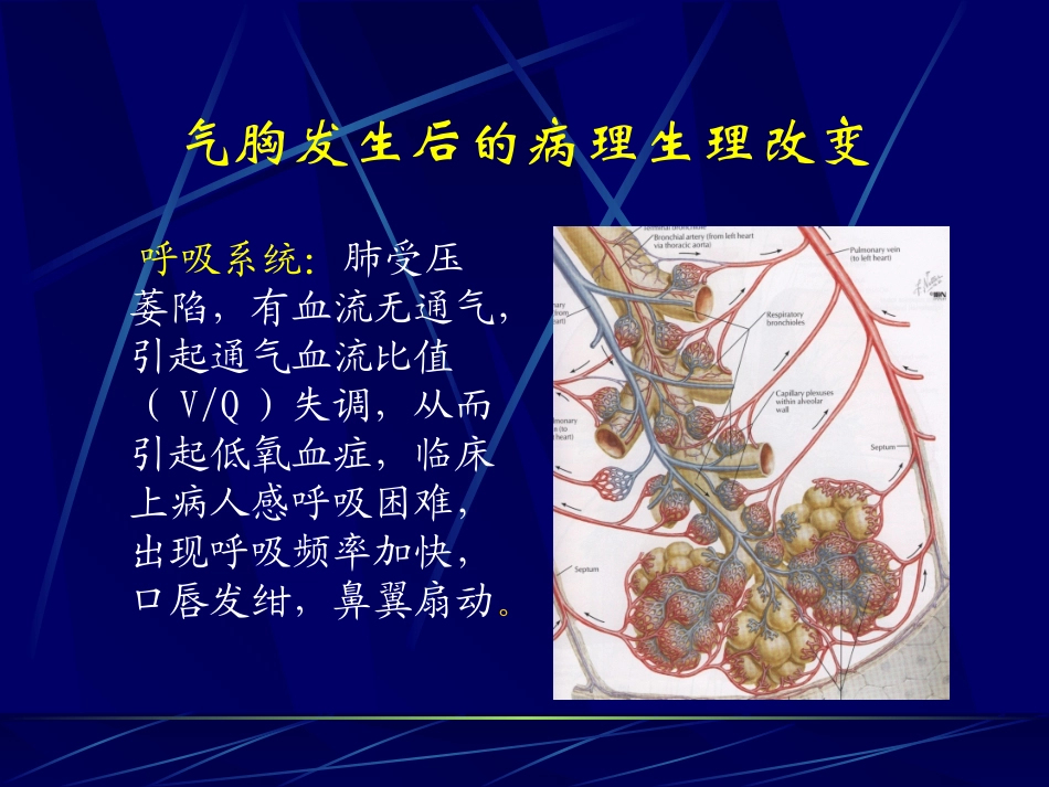 气胸PPT._第3页