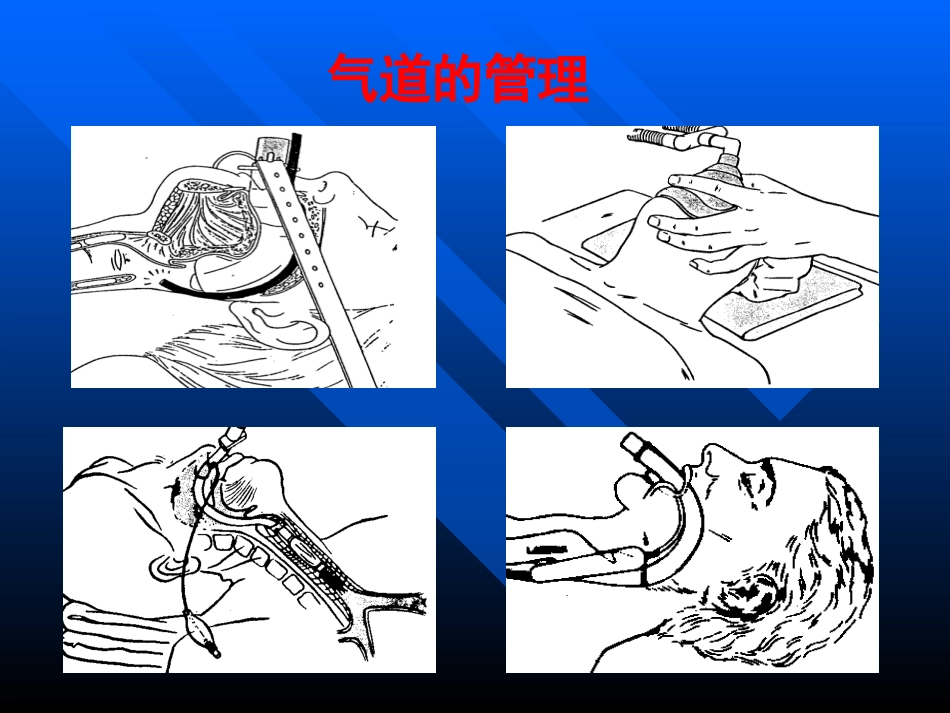 气管及支气管内插管术.._第2页