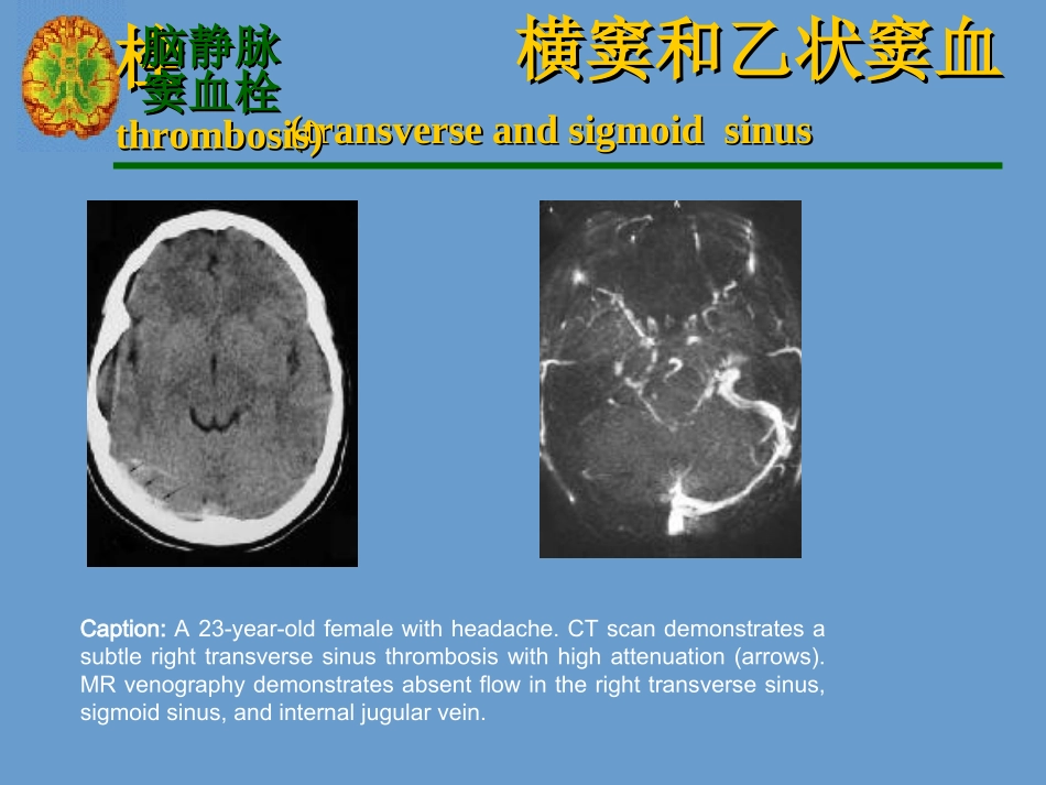 横窦和乙状窦血栓_第2页
