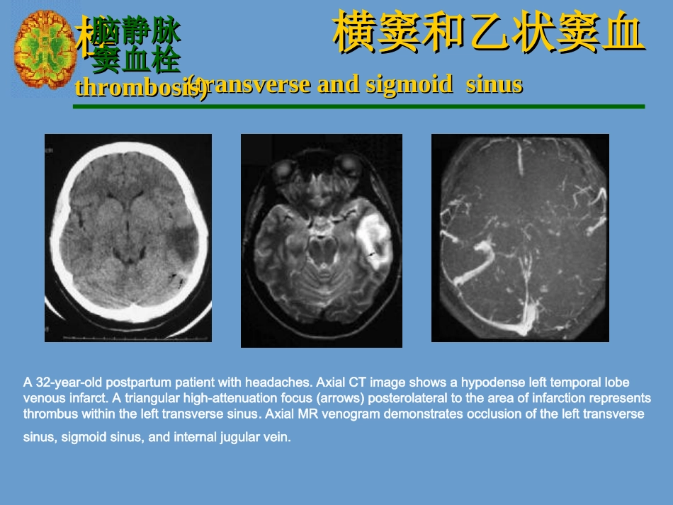 横窦和乙状窦血栓_第3页