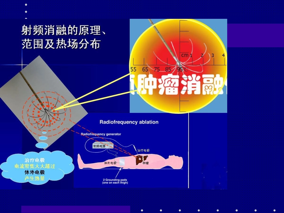 李可柔关于肝癌射频消融手术_第3页