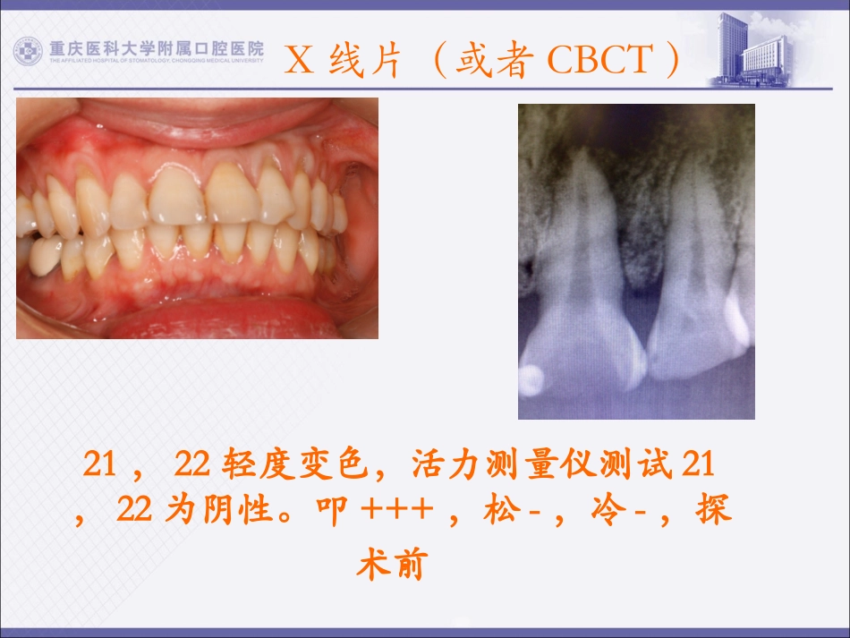 月牙体牙髓病例_第2页