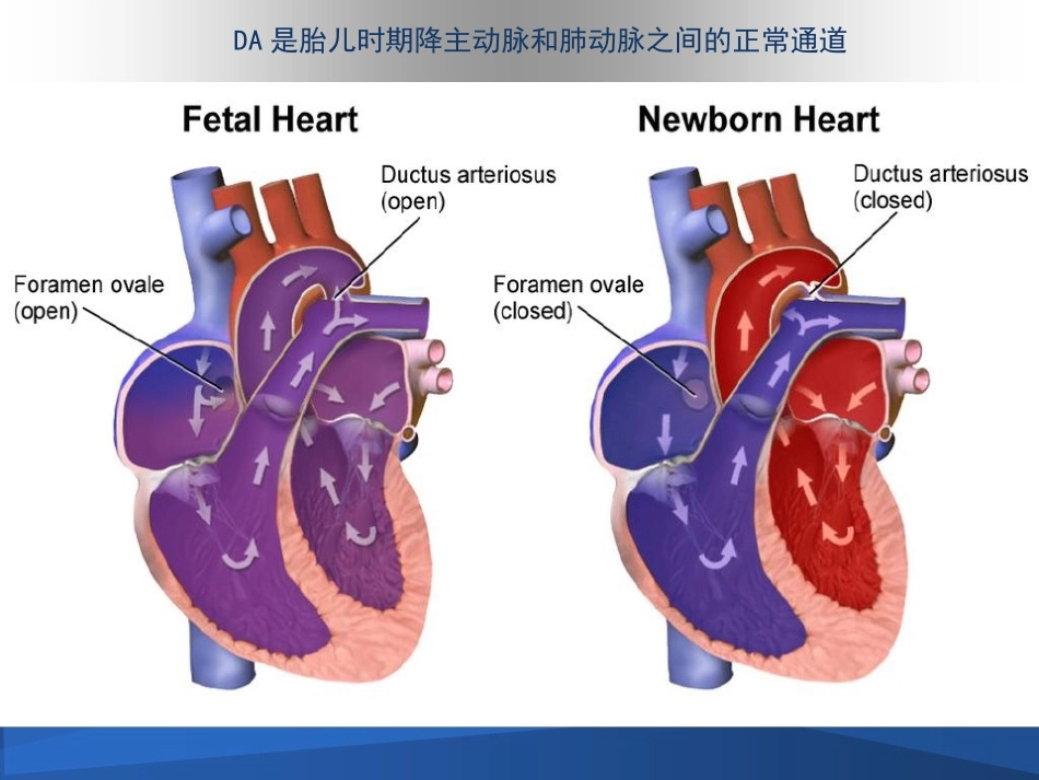 早产儿动脉导管开放_第2页