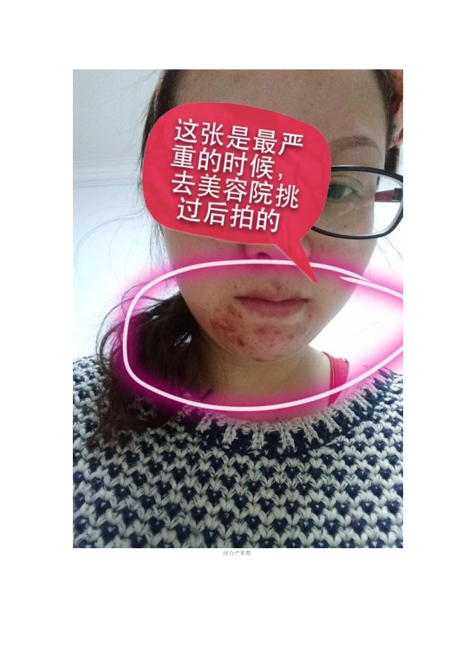 教你如何去除闭合性粉刺_第2页