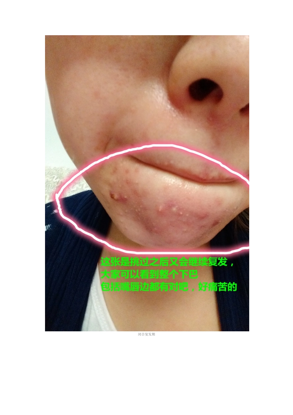 教你如何去除闭合性粉刺_第3页