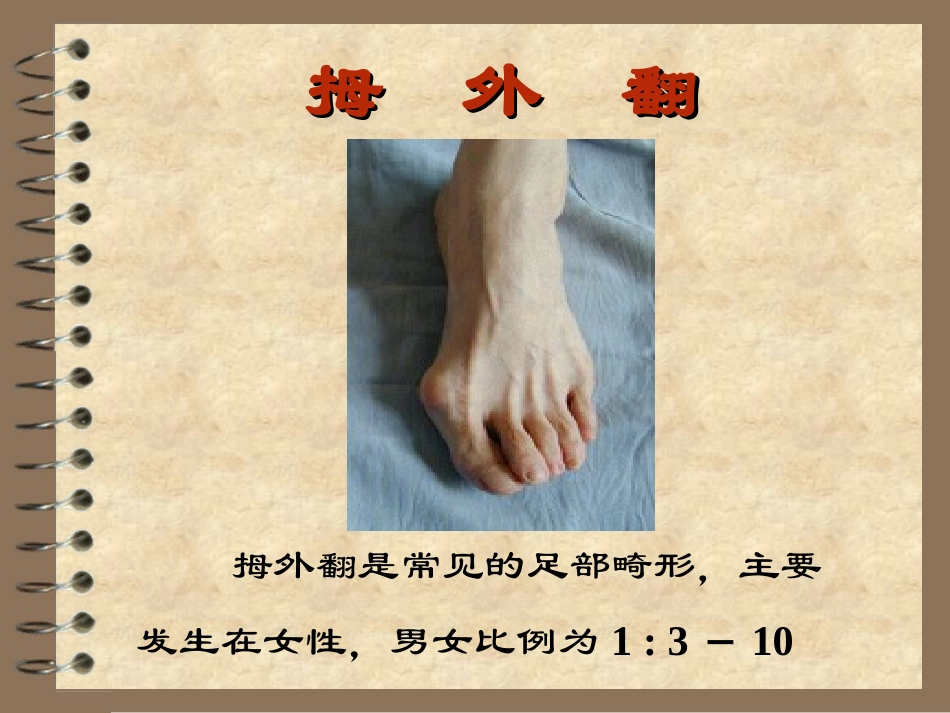拇外翻手术介绍x_第1页