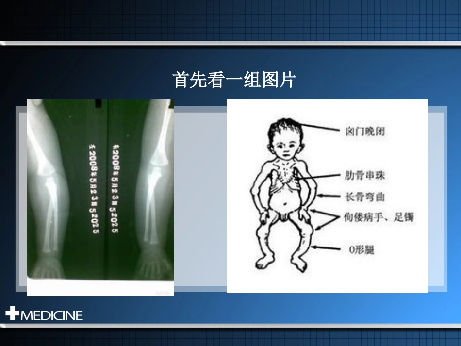 抗维生素D佝偻病_第2页