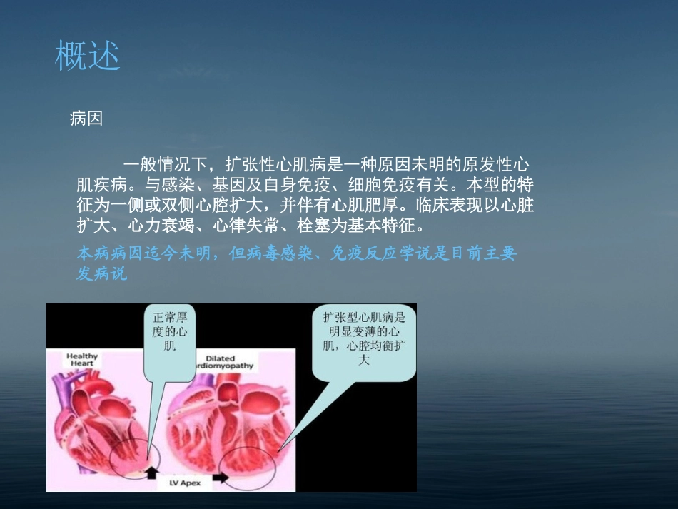 扩张型心肌病_第3页
