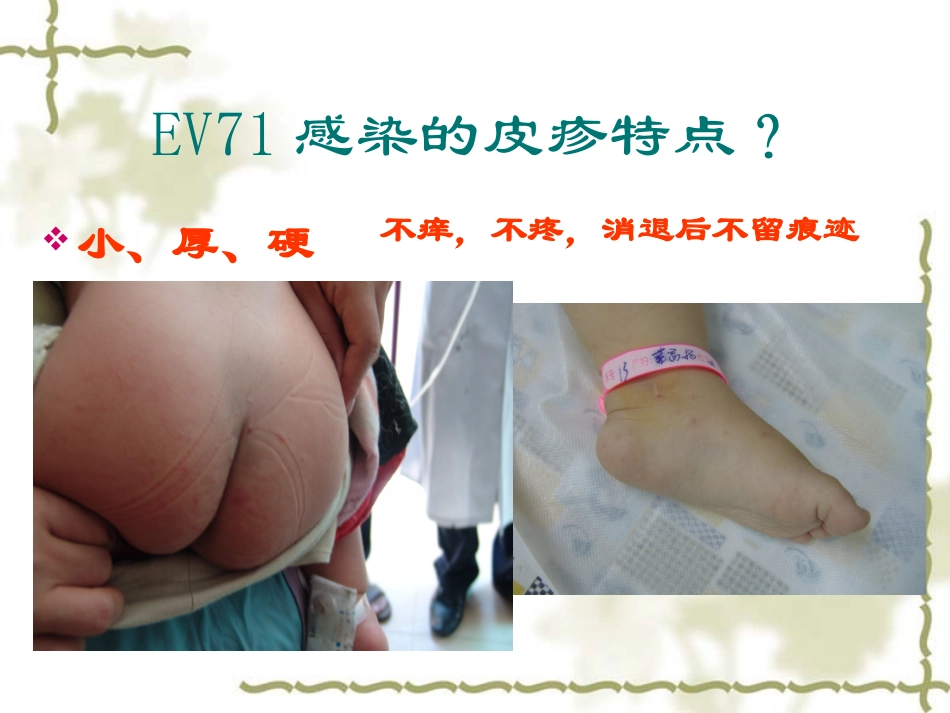 手足口病重症诊治中的相关问题(钱素云)_第3页