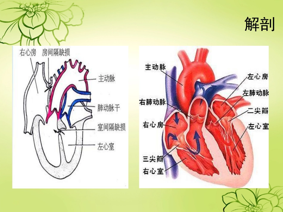 房间隔缺损护理查房_第3页