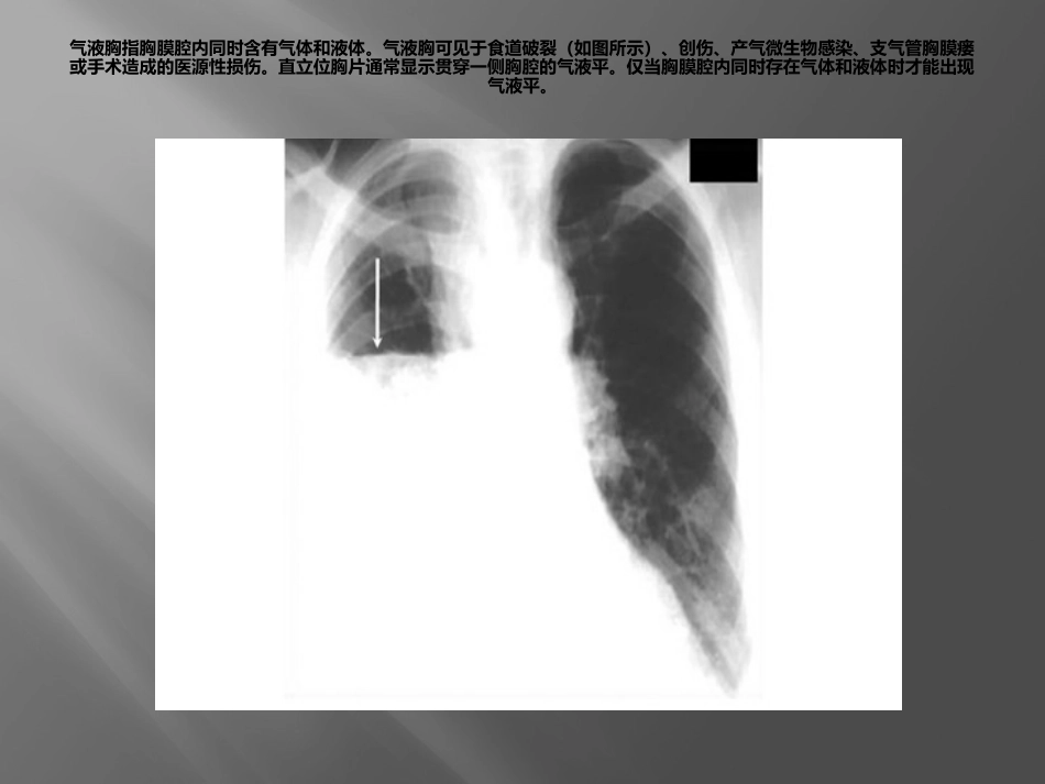 急诊常见X线表现_第3页