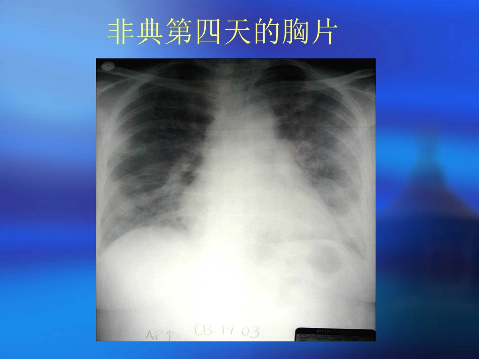 急性肺损伤和急性呼吸窘迫_第2页